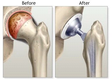 Total Hip Replacement